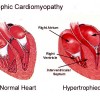 Hypertrophic_Cardiomyopathy_Dia